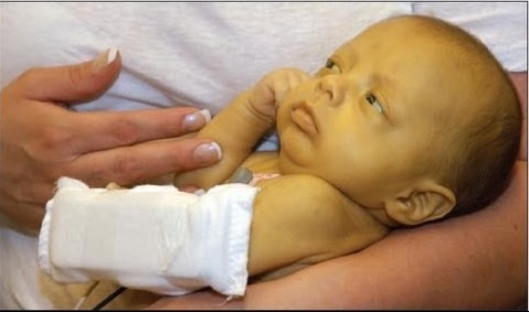 Jaundiced-newborn-in-arm-1